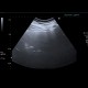 Steatosis of liver, steatosis hepatis, fatty liver, parenchymal sparing: US - Ultrasound